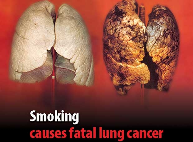 cancer pulmo